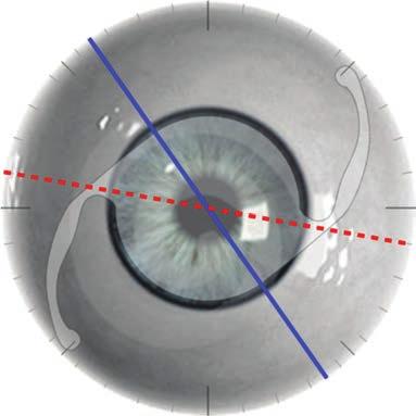 Intraocular lens alignment Thulasi et al. Although some degree of rotation has been noted, repositioning rates of toric IOLs are fairly low, with rates of 1.1% with Acrysof Toric IOL [51] and 3.