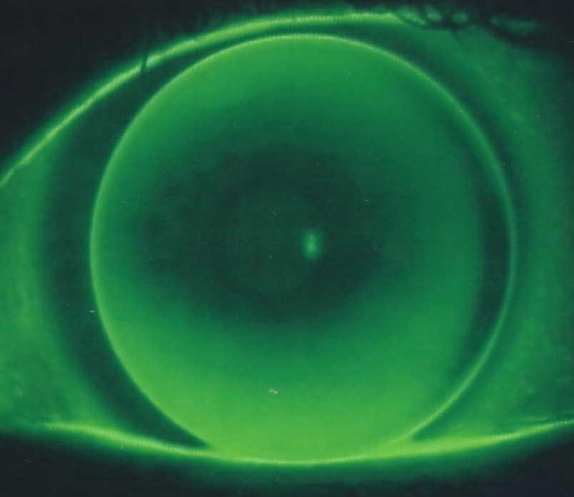 irregular form of the cornea,