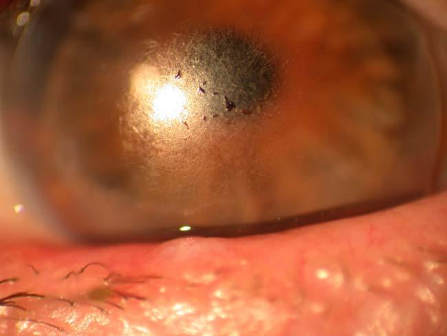 cornea sensitivity Overpass