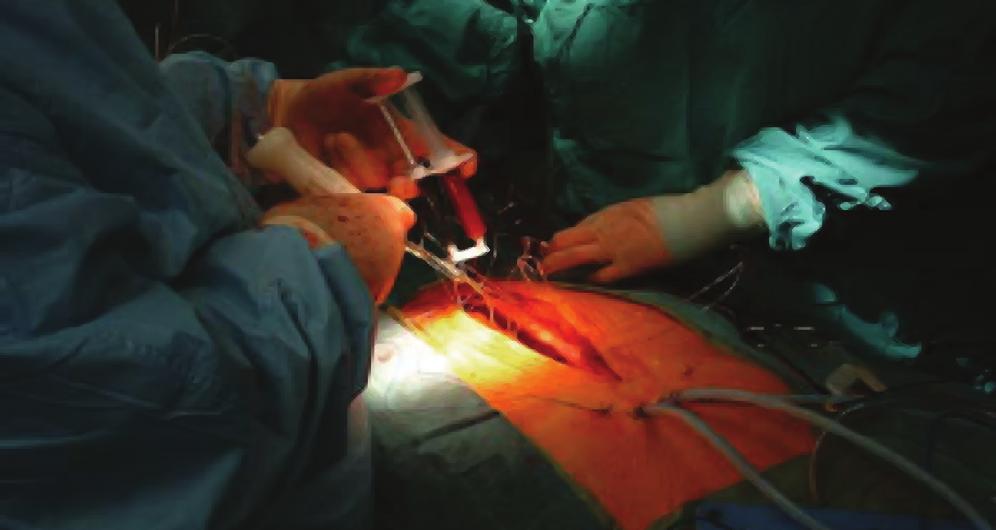 This procedure provides access to the heart and lungs for various types of procedures.