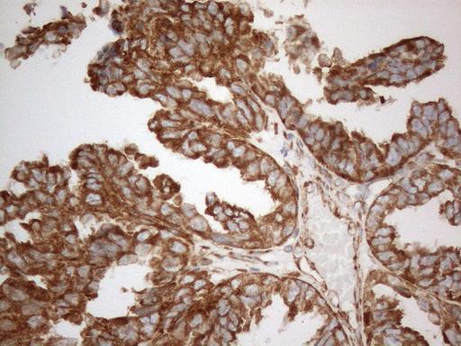 Adenocarcinoma of Human ovary tissue using anti- VAPA