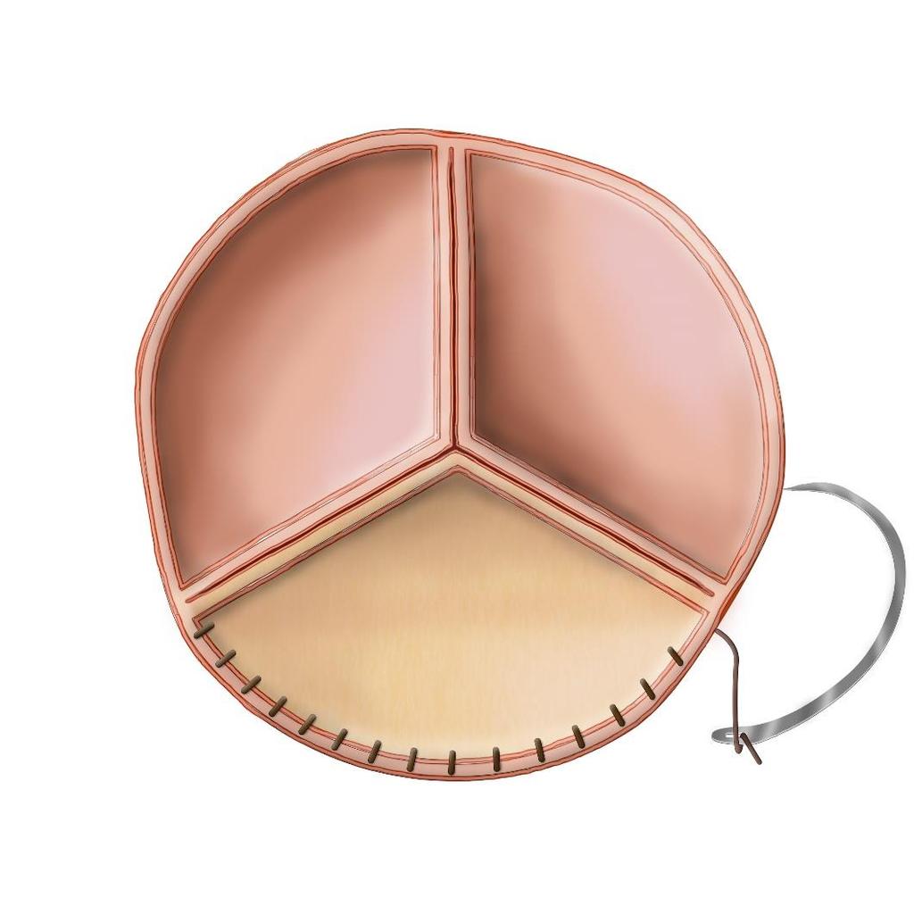 CARDIOCEL AORTIC VALVE CLINICAL STUDY Currently enrolling aortic valve reconstruction study Reconstructing the whole valve instead of replacement with a bio-prosthetic valve 4 leading heart centres