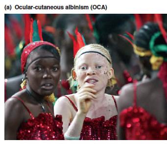 Family pedigrees help unravel the genetic basis of ocular-cutaneous albinism (OCA) OCA
