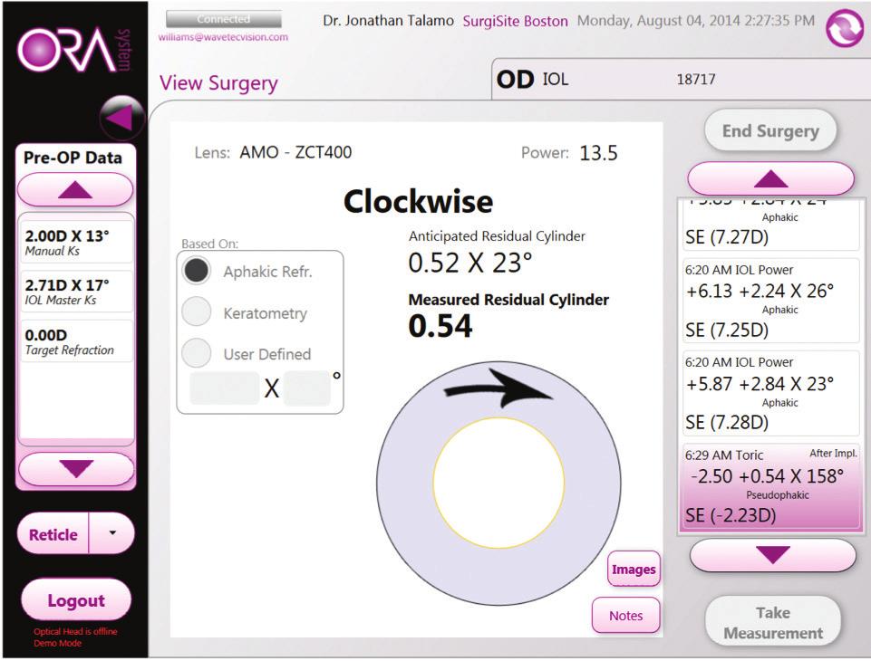 preview screen provides a full field of view, including a live video display of the eye and streaming refractive information so the surgeon can monitor crucial parameters throughout the procedure.