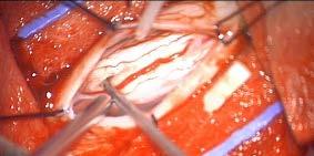 region of cord is preserved and cord appears intact externally Injury leads