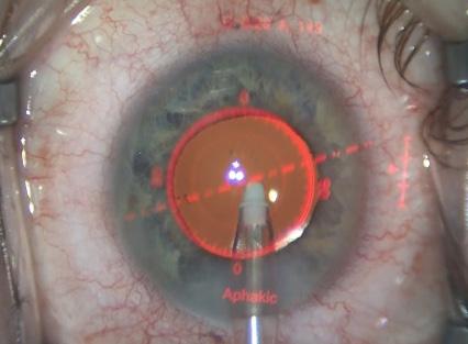 Even if my preoperative calculations are accurate on the spherical power, it is the astigmatic power and axis due to variables such as incisional effect and posterior astigmatism that are taken into