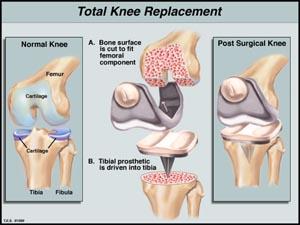 biomechanics Knee less so Difficult kinematics Soft tissue critical to