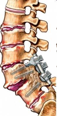 Total disc replacement as an example Pain sources complex in disc space Soft tissue Facet joints Intervertebral disc