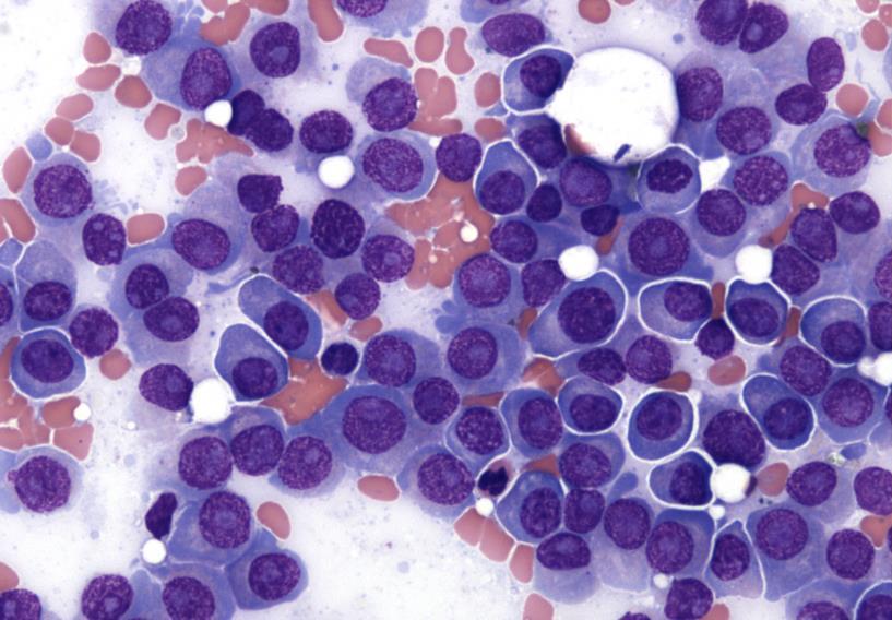 Overview: Multiple Myeloma Multiple myeloma is characterized by malignant plasma cells