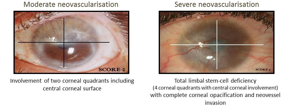 Holoclar indication Holoclar is indicated for the treatment of unilateral or bilateral moderate to severe limbal stem cell deficiency due to physical or chemical ocular burns The patient must be at