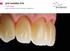 ZIRCONIA BRILLIANT RESULTS WITH THE NEXT GENERATION